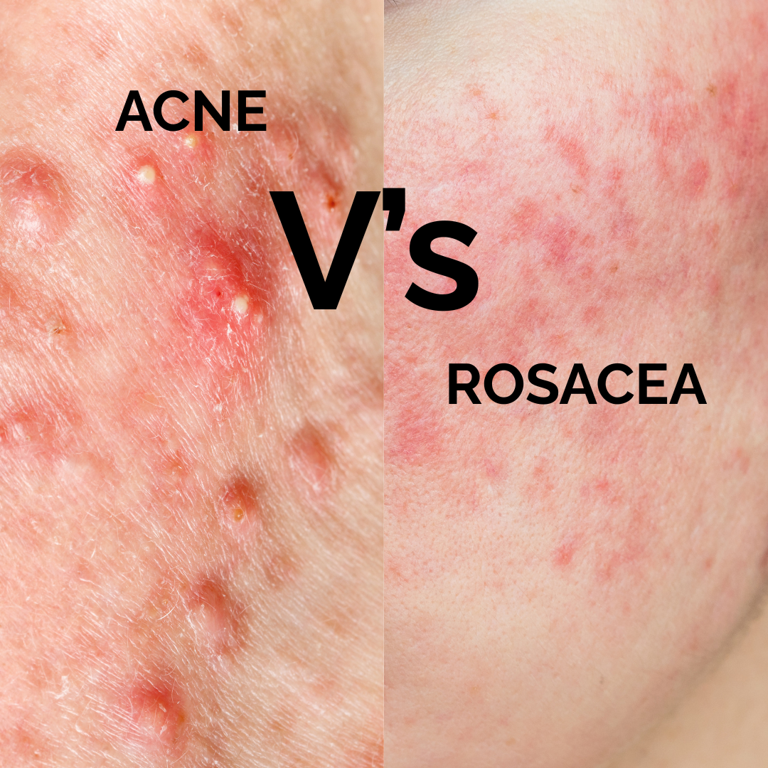 Rosacea vs Acne: How to Tell the Difference