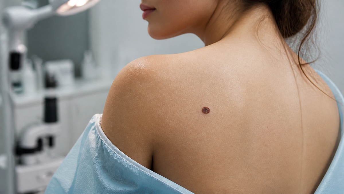 What Mole Removal Is NOT: Clearing Up Common Misconceptions