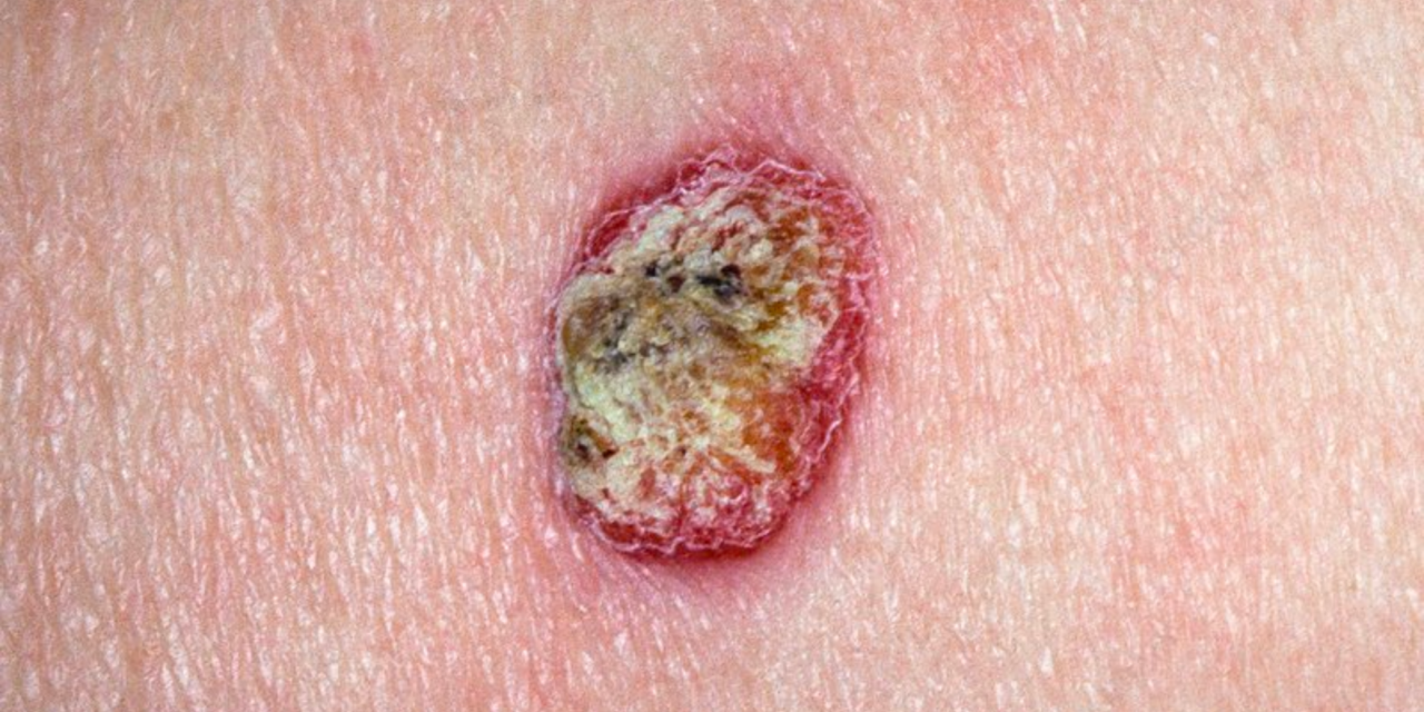 Skin Cancer | The Adare Clinic
